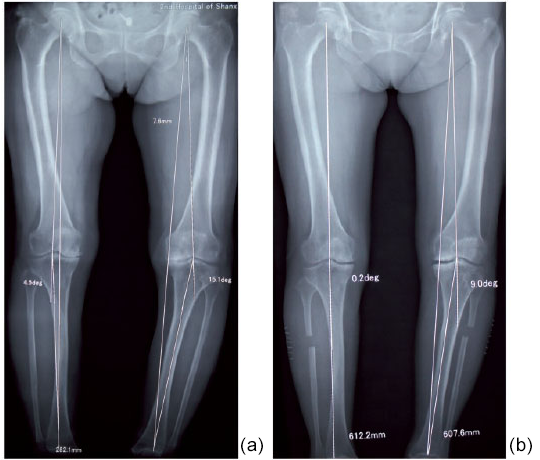 Improvement in the axial alignment of the lower extremity in an old woman with bilateral knee pain after proximal fibular osteotomy